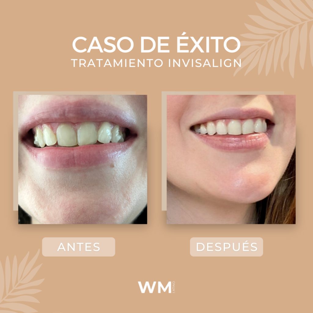 Invisalign experiencia